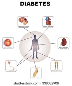 Diabetes complications detailed info graphic on a white background