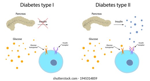 Diabetes Type 1 And 2 Comparison. Pancreas, Insulin Receptor, Glucose Transporter, Cell.