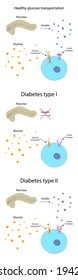 Diabetes Type 1, 2, Healthy Transportation Comparison. Pancreas, Insulin Receptor, Glucose Transporter, Cell.