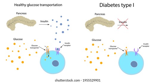 Diabetes Type 1 And Healthy Transportation Comparison. Pancreas, Insulin Receptor, Glucose Transporter, Cell.