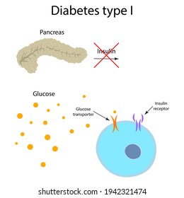 Diabetes Type 1. Pancreas, Insulin Receptor, Glucose Transporter, Cell.