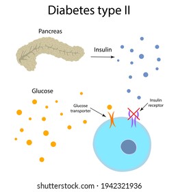 Diabetes Type 2. Pancreas, Insulin Receptor, Glucose Transporter, Cell.