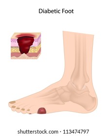 Diabetic Foot  Ulcer