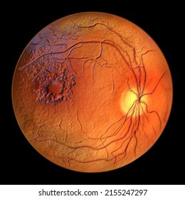 Diabetic Macular Edema (DME), 3D Illustration Showing Cystoid Macula Edema And Disk Edema, Abnormal Finding On Fundoscopic Examination Of The Eye Retina In Diabetes Mellitus