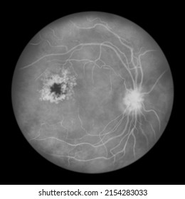 Diabetic Macular Edema (DME), Illustration Showing Cystoid Macula Edema And Disk Edema, Abnormal Finding On Funduscopic Examination Of The Eye Retina In Diabetes Mellitus, Fluorescein Angiography