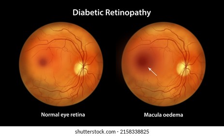 Diabetic Macular Edema (DME), Illustration Showing Normal Eye Retina And Retina With Macula Edema. Fundoscopic Examination Of The Eye Retina In Diabetes Mellitus