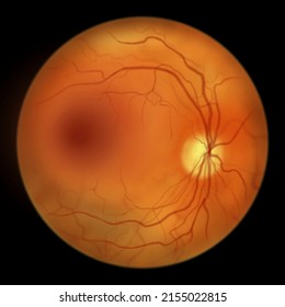 Diabetic Macular Edema (DME). Diabetic Retinopathy, Illustration Showing Macula Edema, Abnormal Finding On Fundoscopic Examination Of The Eye Retina In Diabetes Mellitus