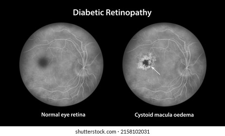 Diabetic Macular Edema (DME). Diabetic Retinopathy, Illustration Shows Cystoid Macula Edema, Abnormal Finding On Fundoscopic Examination Of The Eye Retina In Diabetes Mellitus, Fluorescein Angiography