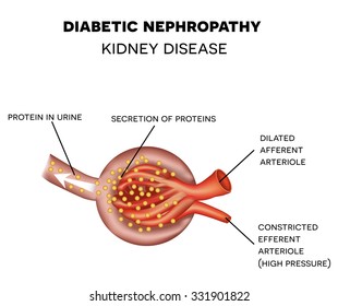 Diabetic Nephropathy Causes The Damage Of Glomerulus, Kidney Disease. 