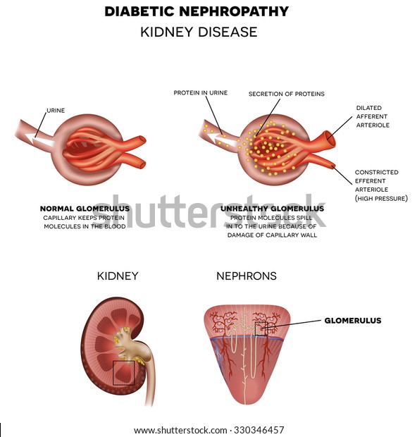 Diabetic Nephropathy Kidney Disease Anatomy Renal Stock Illustration 