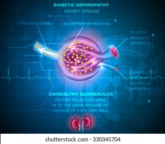 Diabetic Nephropathy, Kidney Disease On An Abstract Blue Technology Background. 