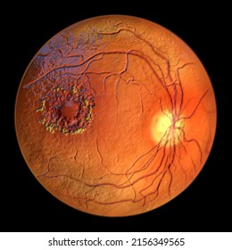 Diabetic Retinopathy, 3D Illustration Showing Macula Edema, Optic Disk Edema And Hard Exudates, Abnormal Finding On Fundoscopic Examination Of The Eye Retina In Diabetes Mellitus