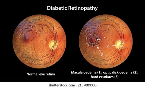 Diabetic Retinopathy, 3D Illustration Showing Macula Edema, Optic Disk Edema And Hard Exudates, Abnormal Finding On Fundoscopic Examination Of The Eye Retina In Diabetes Mellitus