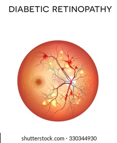 Diabetic retinopathy, damaged retina is the eye disease.