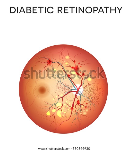 Diabetic\
retinopathy, damaged retina is the eye\
disease.