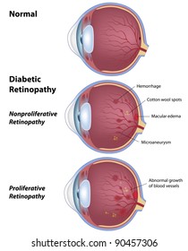 Diabetic retinopathy, eye disease due to diabetes