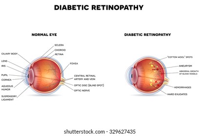 Diabetic retinopathy and healthy eye anatomy
