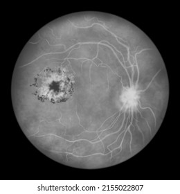 Diabetic Retinopathy, Illustration Showing Cystoid Macula Edema And Hard Exudates, Abnormal Finding On Fundoscopic Examination Of The Eye Retina In Diabetes Mellitus, Fluorescein Angiography