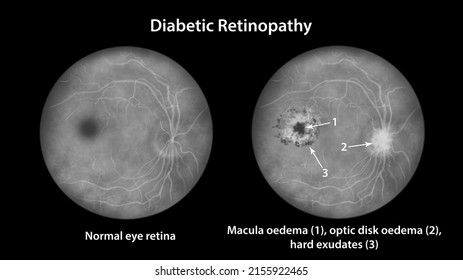 Diabetic Retinopathy, Illustration Showing Cystoid Macula Edema, Optic Disk Oedema And Hard Exudates, Fundoscopic Examination Of The Eye Retina In Diabetes Mellitus, Fluorescein Angiography