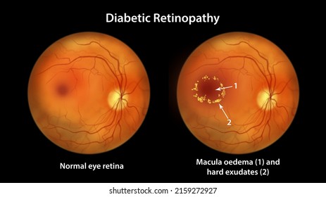 Diabetic Retinopathy, Illustration Showing Macula Edema And Hard Exudates, Abnormal Finding On Fundoscopic Examination Of The Eye Retina In Diabetes Mellitus