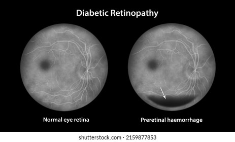 Diabetic Retinopathy, Illustration Shows Preretinal Haemorrhage As Horizontal Blood Level (boat-shaped Haemorrhage), Fluorescein Angiography