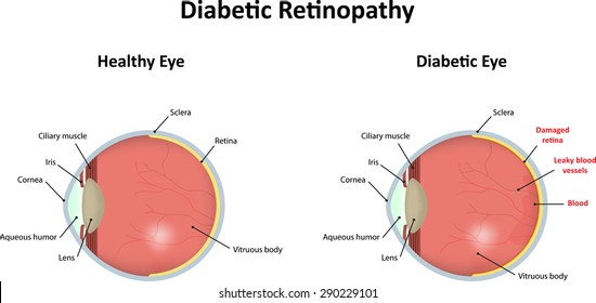 Diabetic Retinopathy Labeled Diagram