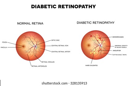 Rétinopathie diabétique et rétine oculaire normale.