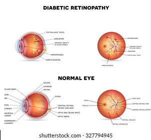 Diabetic retinopathy on a white background, detailed anatomy