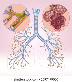 12 Asthma Pathophysiology Images, Stock Photos & Vectors 