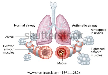 Diagram showing Asthma, normal and asthmatic airways, medically illustration