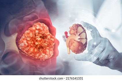 Diagram Showing Different Stages Of Kidney Cancer.3d Illustration