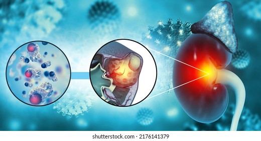 Diagram Showing Different Stages Of Kidney Cancer.3d Illustration