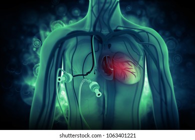 130 Dialysis Access Images, Stock Photos & Vectors | Shutterstock