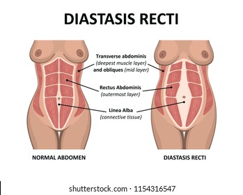 Diastasis recti. Abdominal muscle diastasis after pregnancy pregnancy and childbirth.