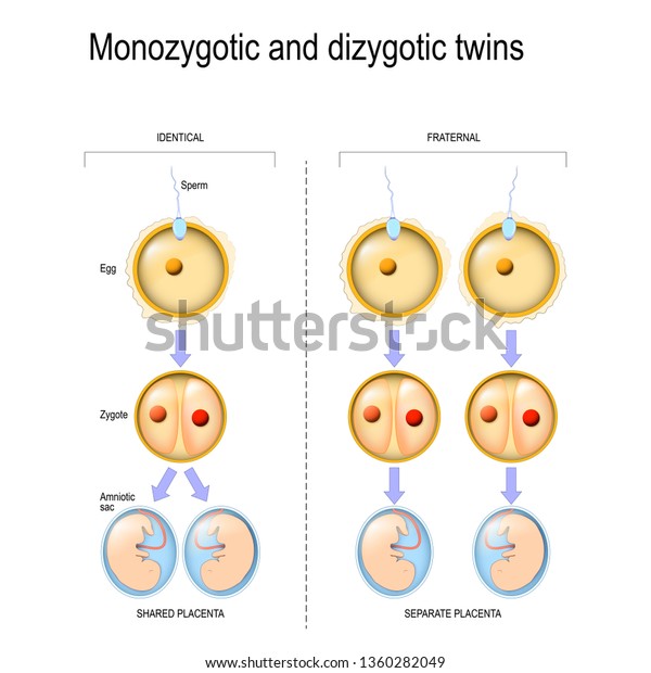 一卵性双生児と二卵性双生児における接合子の発生の差と比較 受精 卵子 卵と精子 から羊膜嚢形成まで イラスト のイラスト素材