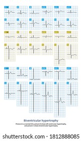 The different degrees of biventricular hypertrophy is manifested in different patterns of ECG, and even normal ECG.