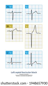 Different Degrees Left Septal Fascicular Block Stock Illustration ...