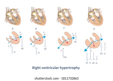 Different Degrees Of Right Ventricular Hypertrophy Will Produce Different Forms Of QRS Waveforms.