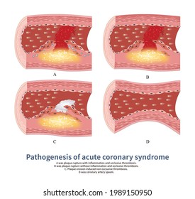 Different Mechanisms Of Coronary Artery Thrombosis Eventually Lead To Acute Coronary Syndrome With Changeable Clinical ECG.