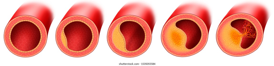 Different stages of arterial disease in atherosclerosis, accumulation of cholesterol and fats in the walls, with rupture of the atheroma plaque. schematic and descriptive illustration.