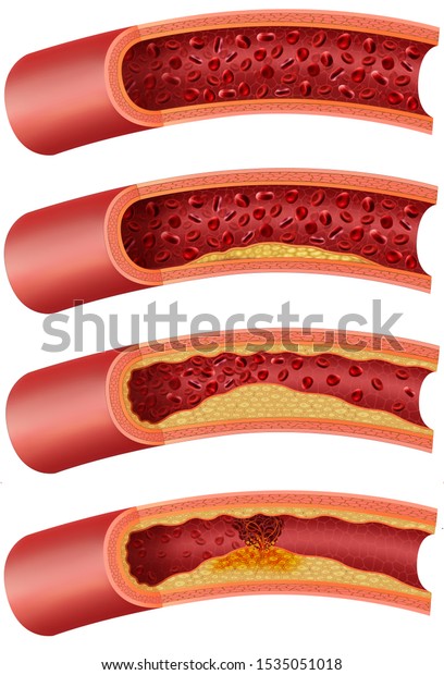 動脈硬化症の様々な段階 壁にコレステロールや脂肪が蓄積する過程 概略図と説明図 のイラスト素材