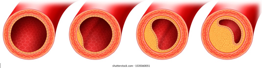 动脉硬化图片 库存照片和矢量图 Shutterstock