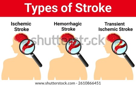 Different types of brain stroke. Ischemic, Hemorrhagic, Transient Ischemic stroke. Types of stroke with magnifying glass isolated on white background. Element for human brain disease and neuroscience.