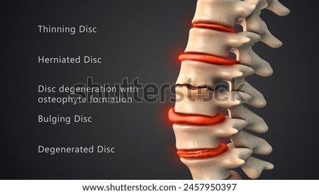 Difficulties with the human spinal discs 3d illustration