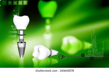 Digital illustration Dental implant in colour background 