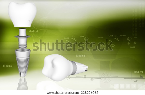 Digital Illustration Dental Implant Colour Background Stock ...