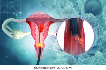 Dilation And Curettage (d And C).endometrial Biopsy.cervical Cancer.3d Illustration