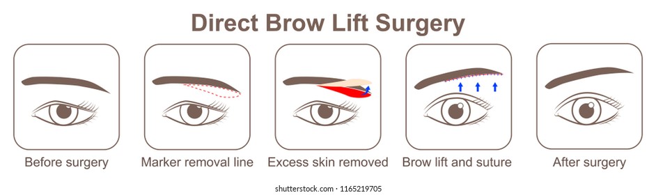 Direct Brow Lift Surgery