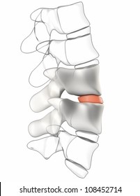 66 Osteophyte formation Images, Stock Photos & Vectors | Shutterstock