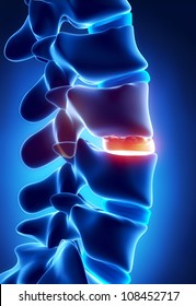 Disc Degenerated By Osteophyte Formation